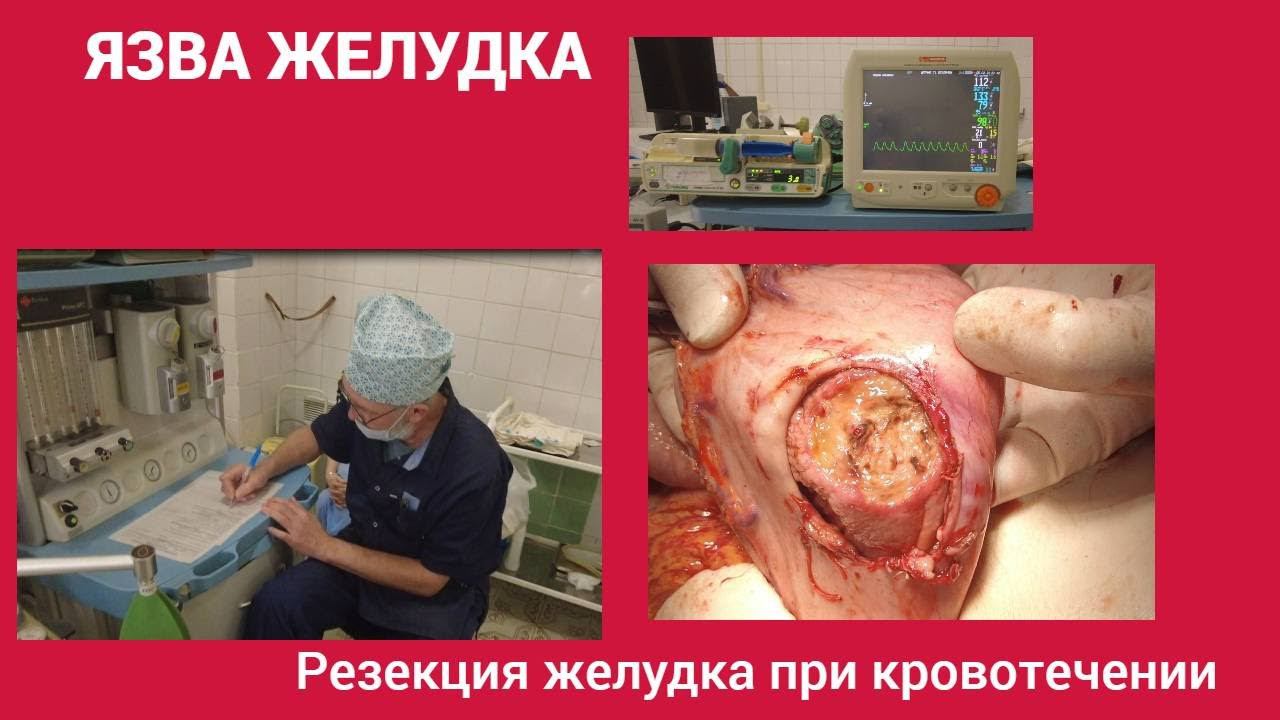 Язва желудка. Резекция желудка при язвенном кровотечении.