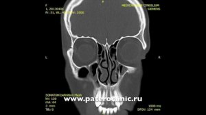 Компьютерная томография носа