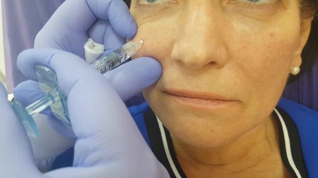 Делаем скулы. Объёмная коррекция средней трети лица.Dr.Valeriy Potiy смотреть онлайн