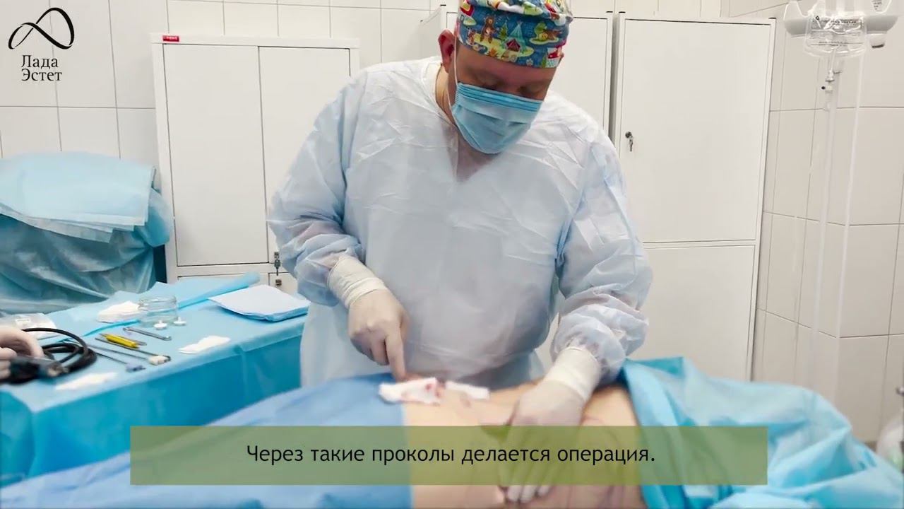 Липосакция Vaiser. Пластическая хирургия Лада Эстет Ижевск