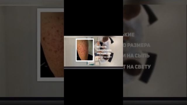 Ноги расскажут о состоянии печени. Признаки болезней печени. Если есть симптом, пора чистить печен смотреть онлайн