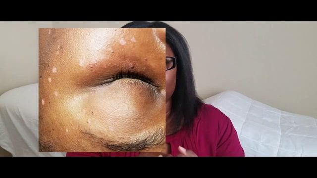 Skin Classic on skin tags/moles.. Yay or Nay?? смотреть онлайн