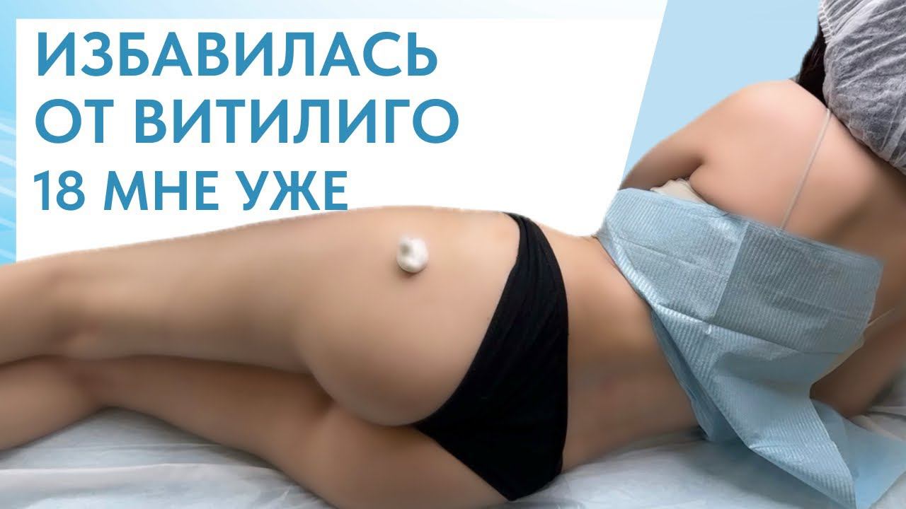 18+ | С КАКОГО ВОЗРАСТА МОЖНО ДЕЛАТЬ КАМУФЛЯЖ ВИТИЛИГО
