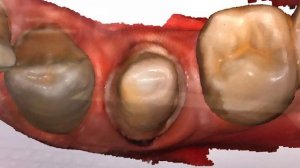 Изготовление коронки с применением интраорального сканера MEDIT i500 intraoral scanner