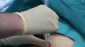 Использование надлобкового катетера Фолея