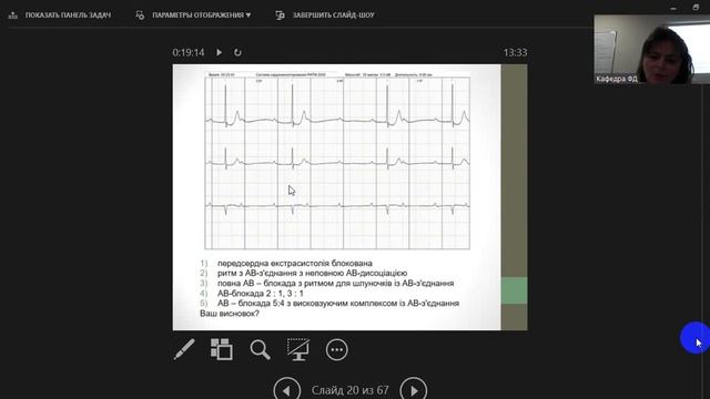 ЕКГ діагностика AV- блокад. (А.П. Вережнікова). Семінар 13.12.2022р. смотреть онлайн