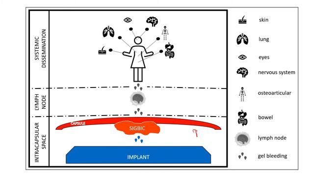Silicone disease. Introduction to breast implant illness (BII) смотреть онлайн
