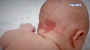 Гемангиома у детей | История болезни 25.08.2022