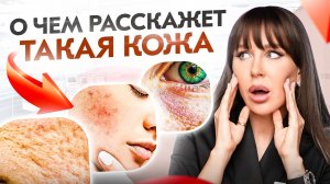 Прыщи, дерматит, псориаз, розацеа. Что кожа расскажет о твоем кишечнике?