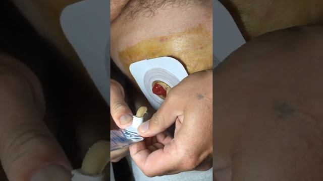 Стомакс при замене калоприемника Конватек у пациента с илеостомой смотреть онлайн