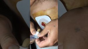 Стомакс при замене калоприемника Конватек у пациента с илеостомой