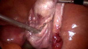 Лапароскопическое удаление кисты яичника