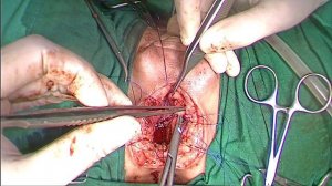 Облитерация бульбомембранозного отдела уретры. Стриктура уретры. Анастомотическая пластика.