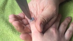 Вскрытие подногтевой гематомы 2