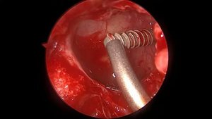 Удаление инородного тела верхнечелюстной пазухи. Maxillary sinus foreign body removal.