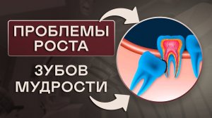 ПРОБЛЕМЫ РОСТА ЗУБОВ МУДРОСТИ. Влияние ЗУБА МУДРОСТИ на ЗУБНОЙ РЯД.