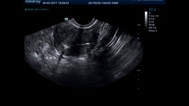 Показательная проходимость маточных труб смотреть онлайн