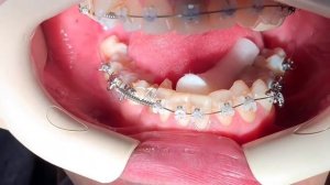 Установка ортодонтической кнопки, замена ортодонтической дуги, установка ортодонтической пружины.