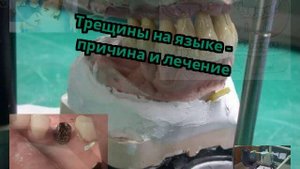 Трещины на языке - причина и лечение