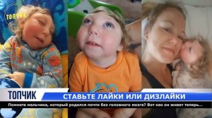 Помните мальчика, который родился без головного мозга Вот как он живет теперь!!!