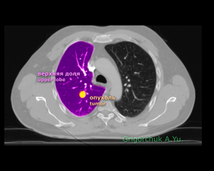 Метастаз рака почки удален торакоскопически с сохранением легкого. Metastasis removed by VATS.