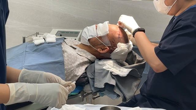 3000 GRAFTS FUE HAIR TRANSPLANT PROCEDURE IN SOUTH KOREA! смотреть онлайн