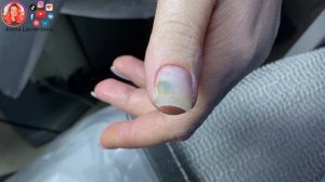 Позеленел ноготь под гелем ? / Псевдомония на ногтях