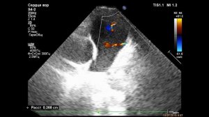 Коронарно-лёгочные фистулы/ coronary fistula