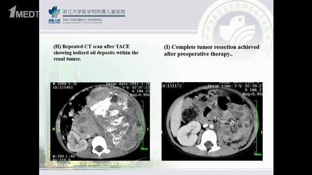 Минью Ли (Китай) – Неоадъювантная транскатетерная артериальная химиоэмболизация смотреть онлайн