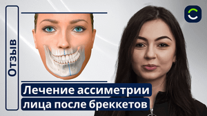 Лечение Ассиметрии Лица После Бреккетов | Отзывы Наших Пациентов