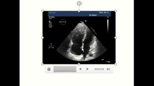 Hemodynamically Significant ASD - Soha Romeih