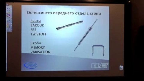 Корригирующие остеотомии при Hallux Valgus с использованием фиксаторов от Biomet