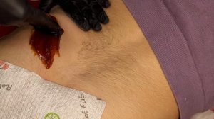 Удаление Волос на Пояснице. Женский Шугаринг.