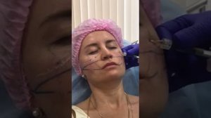 Belotero Soft коррекция носослёзной борозды.Belotero Volume коррекция скул.