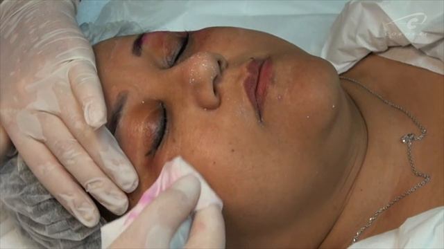 Пилинг после блефоропластики смотреть онлайн