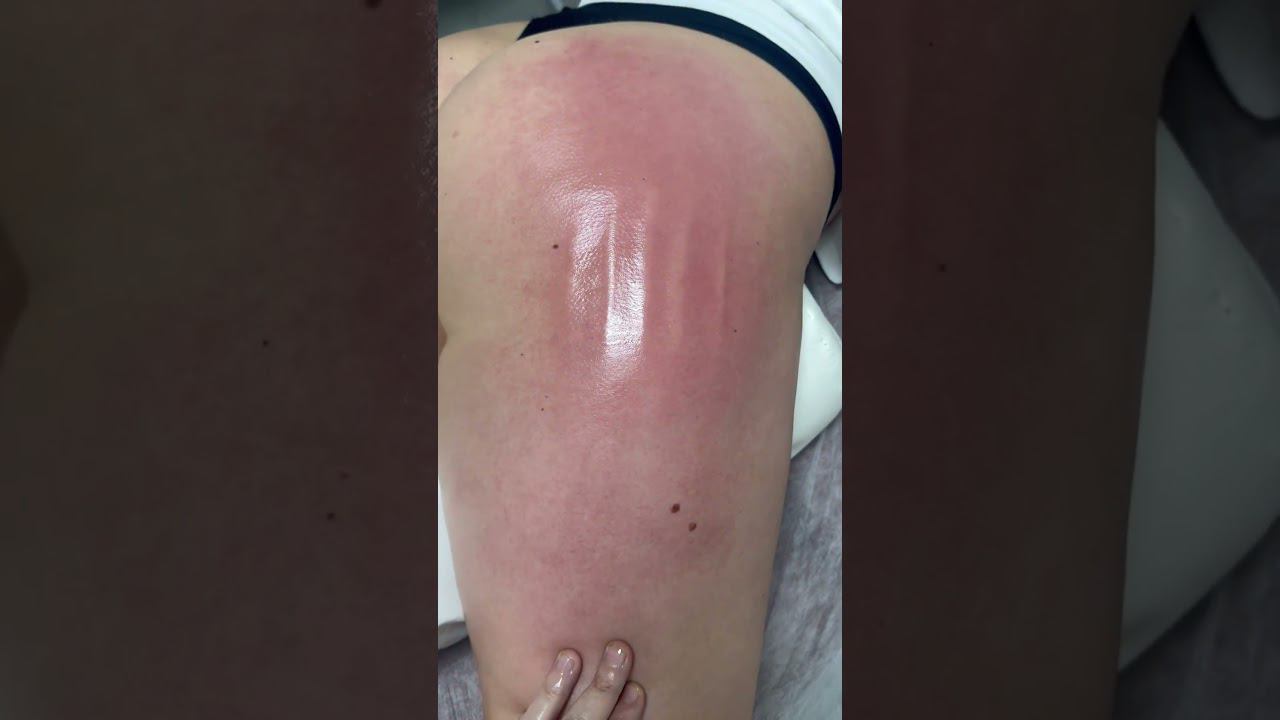 Ручная липосакция зоны галифе #massage #tiktok #shortvideo #массаж #youtubeshorts