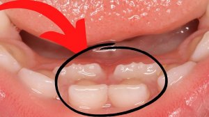 Зубы растут в 2 ряда. Что делать?