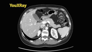 Фазы болюсного контрастирования на КТ