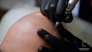 Трихопигментация - лучше чем пересадка волос!  Scalp MicroPigmentation