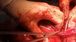 Врастание плаценты после миомэктомии. Placenta perctreta after myomectomy