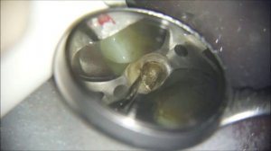 Удаление литой культевой вкладки