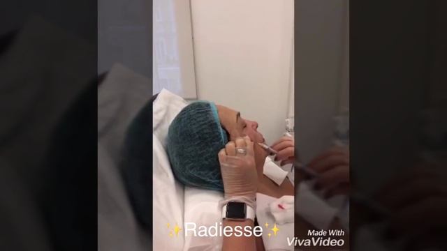 Процедура Радиесс. Филлер Радиесс в скулы. А Клиника. смотреть онлайн