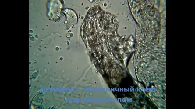 Демодекс -- железничный клещ смотреть онлайн