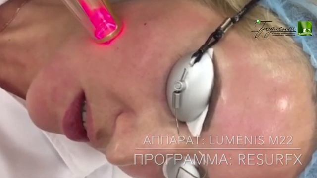 Фотофракшен на аппарате M22 - в клинике Градиент смотреть онлайн