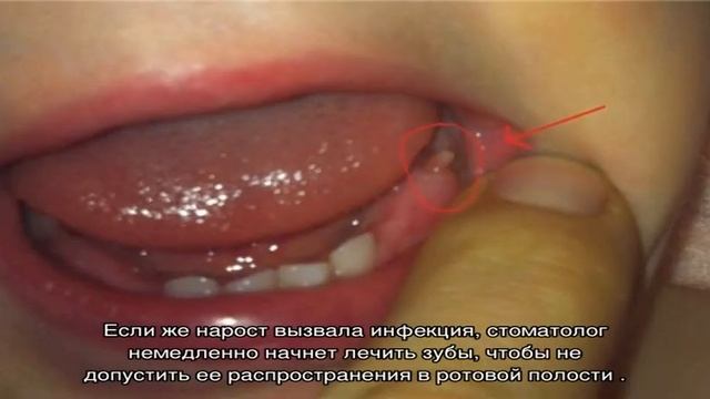 Нарост на десне у ребенка смотреть онлайн