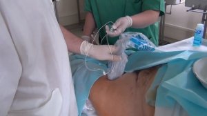 Передняя проксимальная блокада седалищного нерва