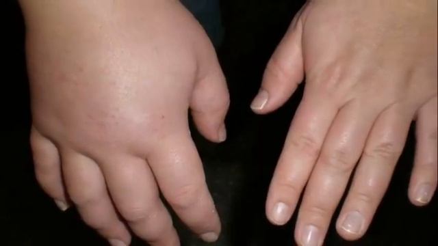 Быстро убрать ОТЁКИ на ногах. Как убрать отёки на лице. Как убрать мешки под глазами