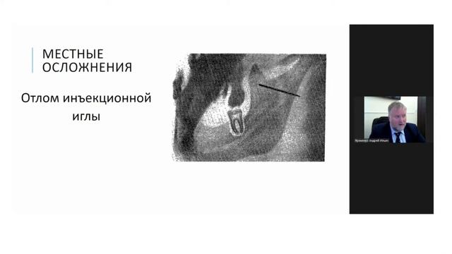 Осложнения анестезии в стоматологии