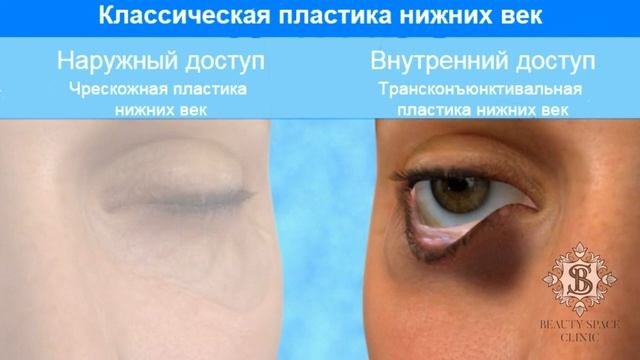 Как убрать мешки под глазами без разрезов?