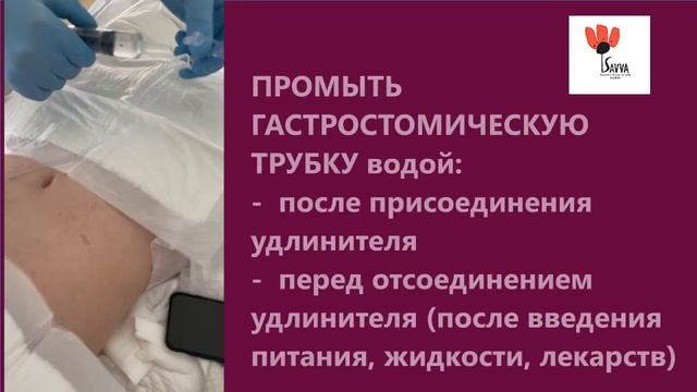 Присоединение удлинителя к гастростомической трубке низкопрофильная баллонная Т Шубина, И Захаров смотреть онлайн